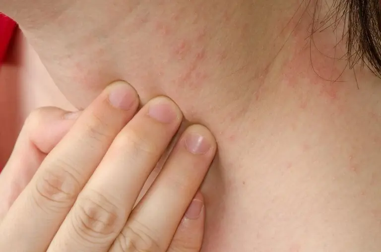 Could Persistent Itching Be a Sign of a Liver Problem? Here's What You Should Know