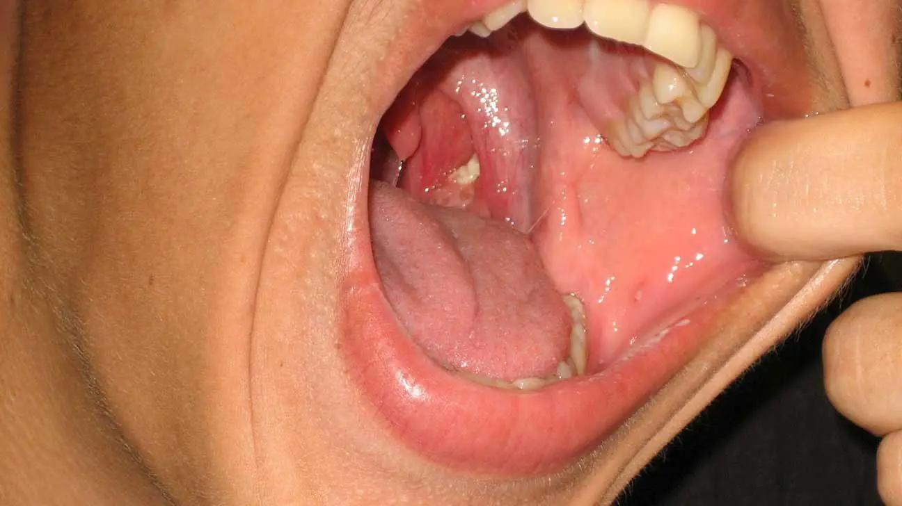 Suddenly Feeling Something Stuck in Your Throat? A Small Lump May Reveal More Than You Think