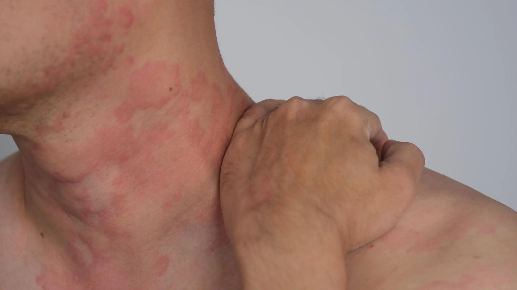 The Silent Danger on Your Skin: Why Hives with Breathing Problems Should Never Be Ignored
