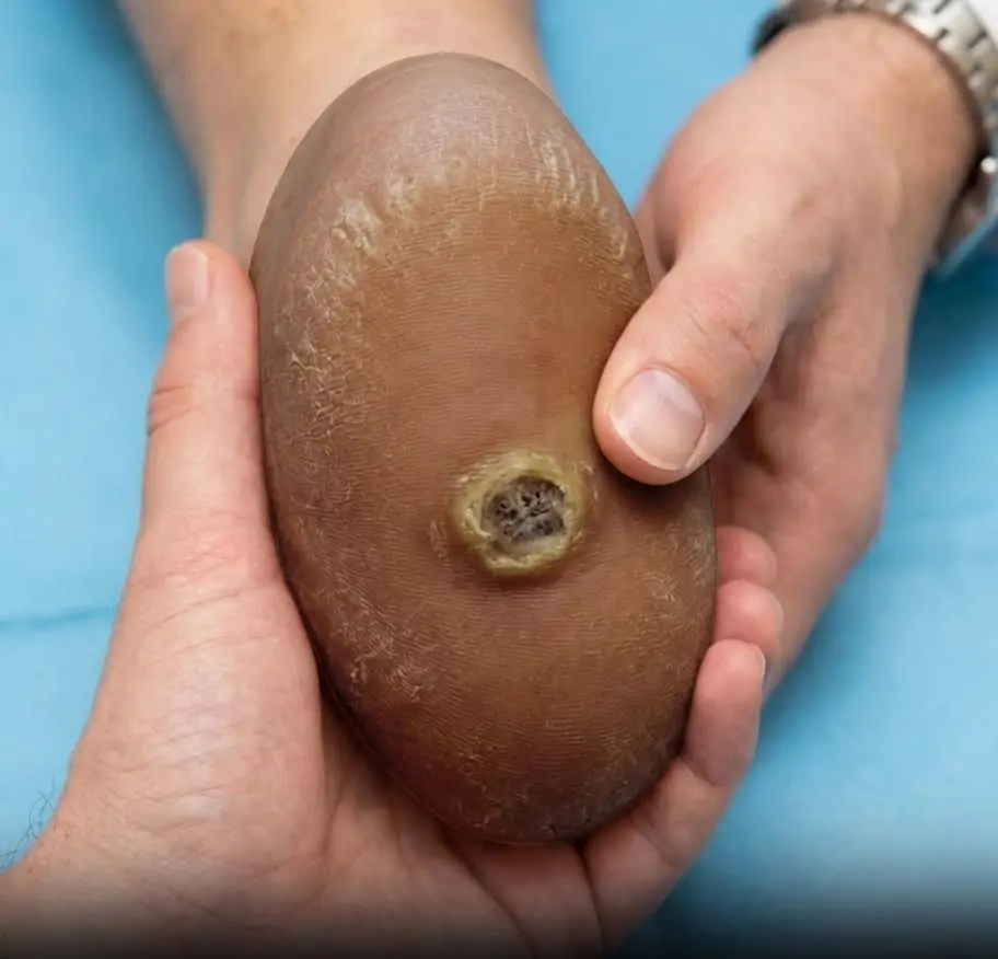 Don’t ignore a plantar callus just because it looks small. It can slowly grow deeper under the skin and become harder to treat later on.