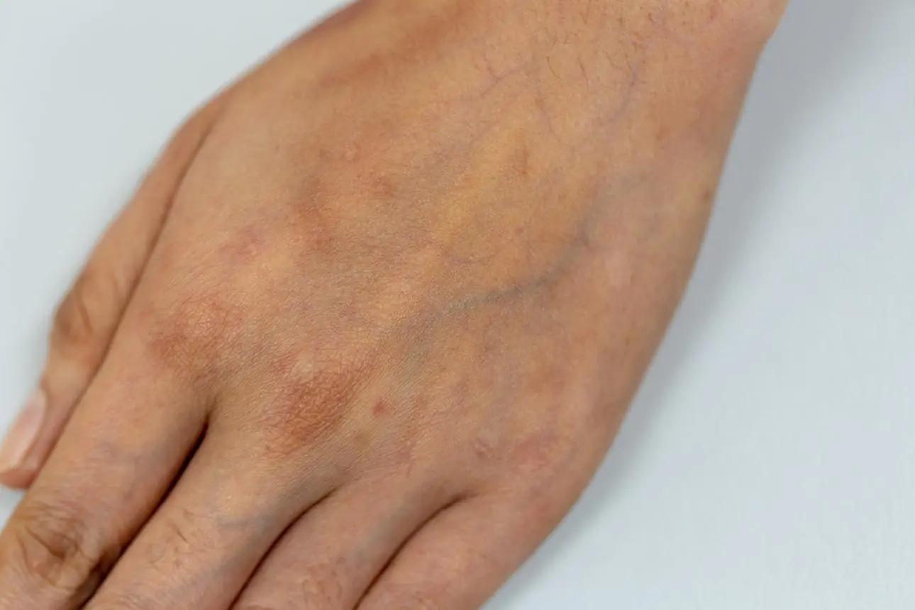 Visible Veins on Your Hands? Here’s What They Could Mean for Your Health