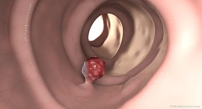 Don't Ignore Colon Polyps—Early Detection Can Save Lives