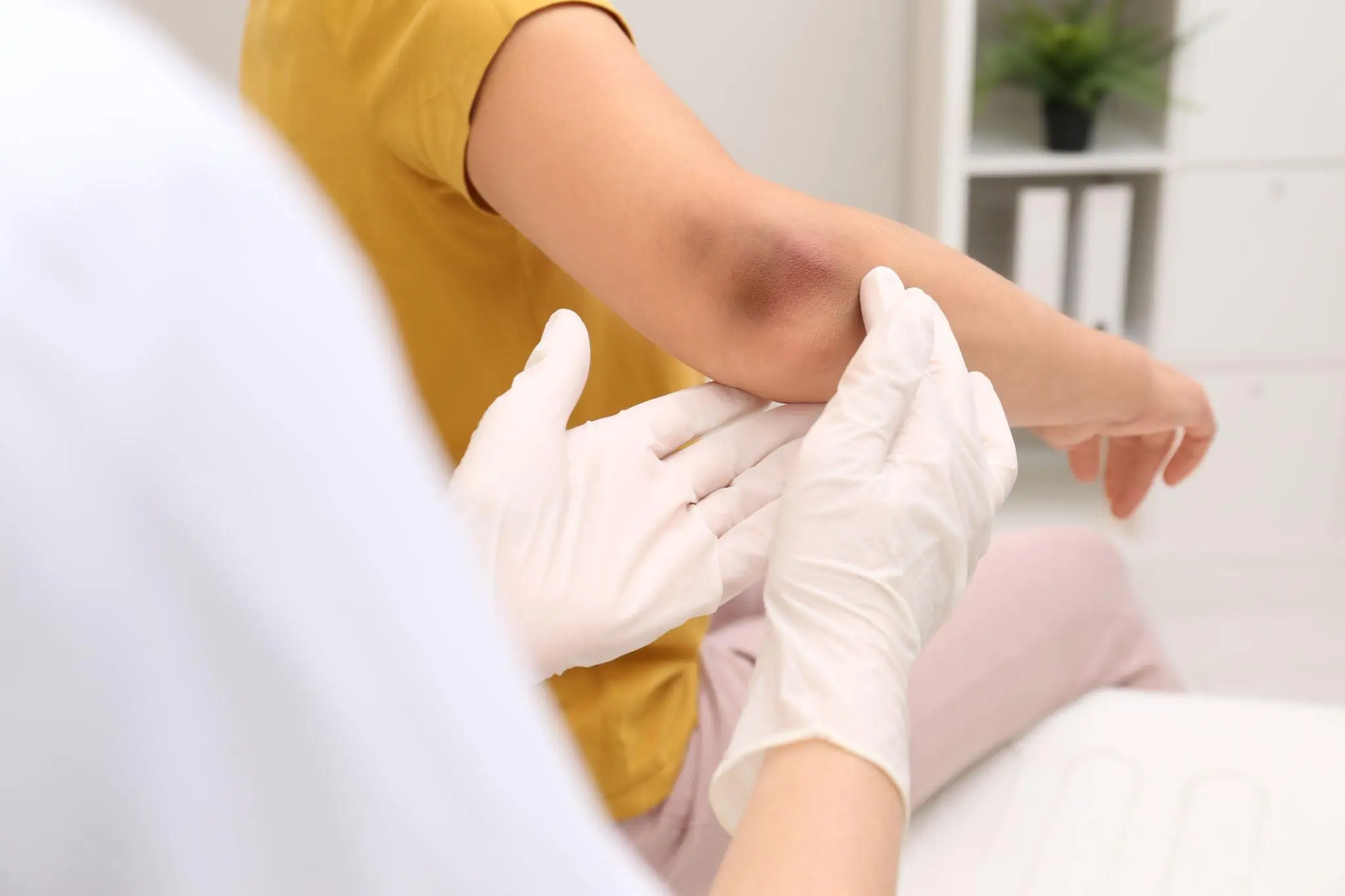 Bruises on Your Body May Be Warning You About an Underlying Health Problem