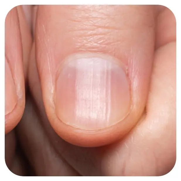 Do Vertical Lines on Your Nails Mean Something? Here's What Your Nails May Be Trying to Tell You