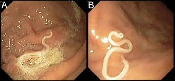Experts Say These 4 Foods May Increase Your Risk of Parasite Exposure