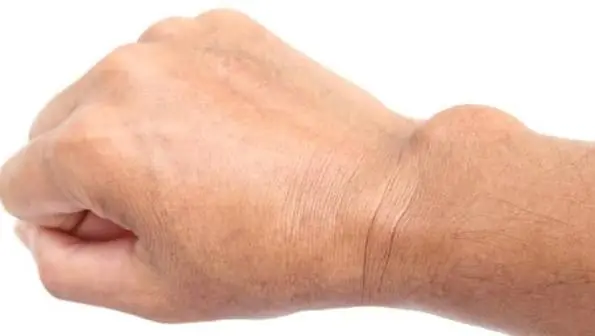 A New Lump on Your Hand? Learn What It Could Mean Before Ignoring It