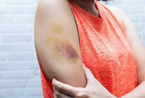 If You Bruise Easily, Don't Ignore These Possible Warning Signs