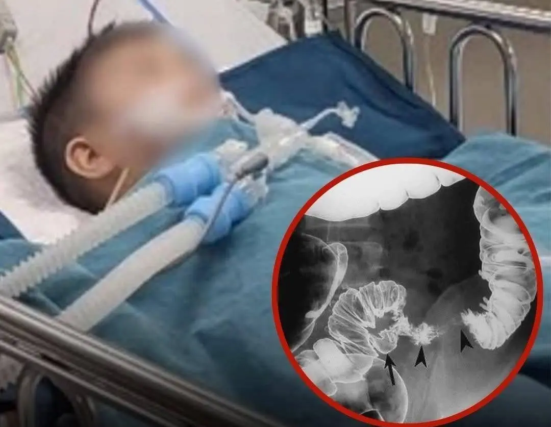 Second-Grader Diagnosed with Colon C.anc.er After Regularly Eating These 2 Foods Since Childhood