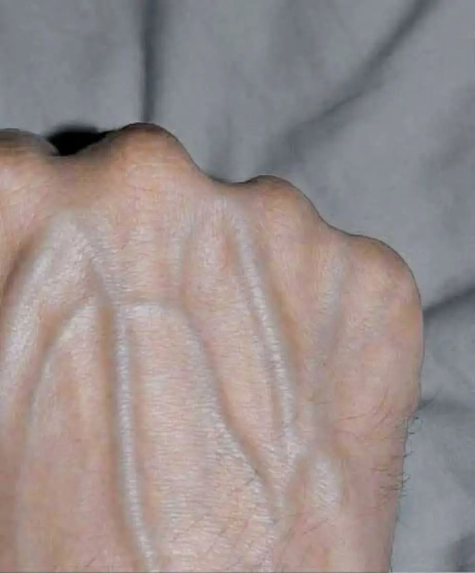 If your veins are visible in your hand, it is a signal of ca…
