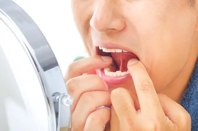 5 Warning Signs of Oral Can.cer You Should Never Ignore