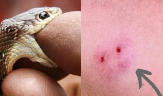 If bitten by a poisonous snake, is it safe to suck on the wound with your mouth?