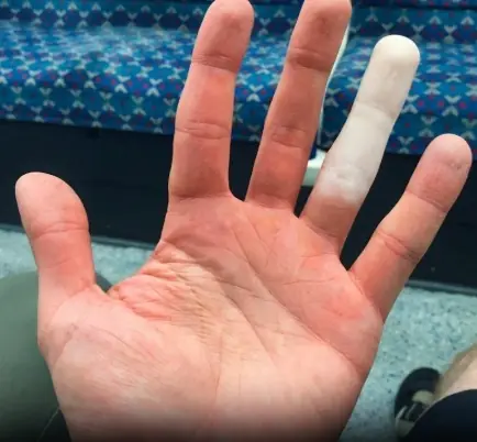 If Your Fingers Turn White in the Cold, Your Body May Be Warning You About Something