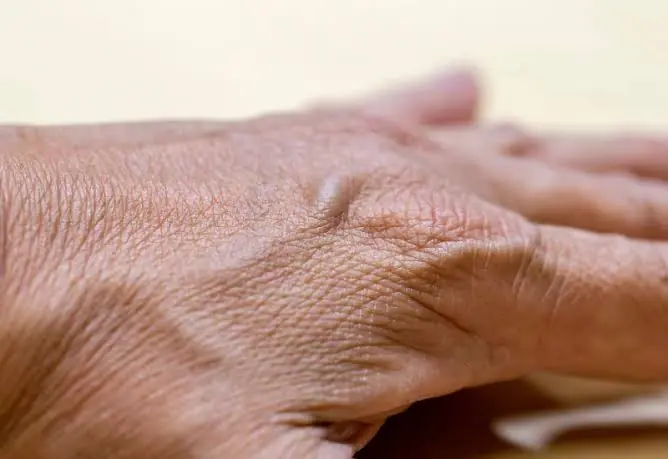 When Should You Worry About Visible Hand Veins? Experts Explain.