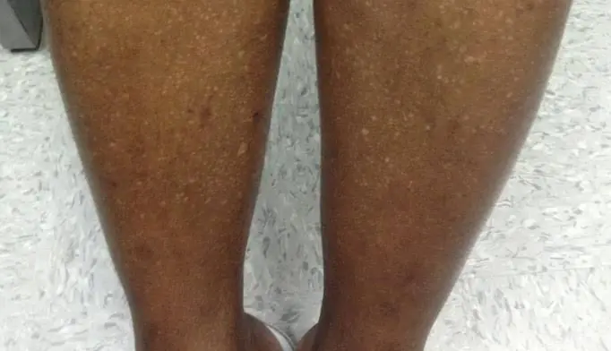 Small White Spots on Your Skin? Here's What Specialists Want You to Know