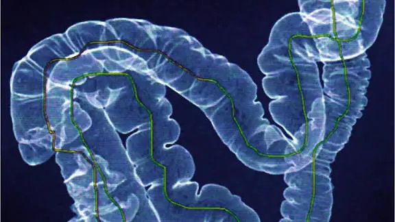 Colon Cancer Often Starts Quietly—Watch for These 5 Warning Signs
