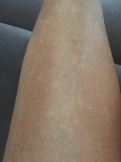 Tiny White Spots on Your Arms or Legs? Here’s What They Could Be Telling You