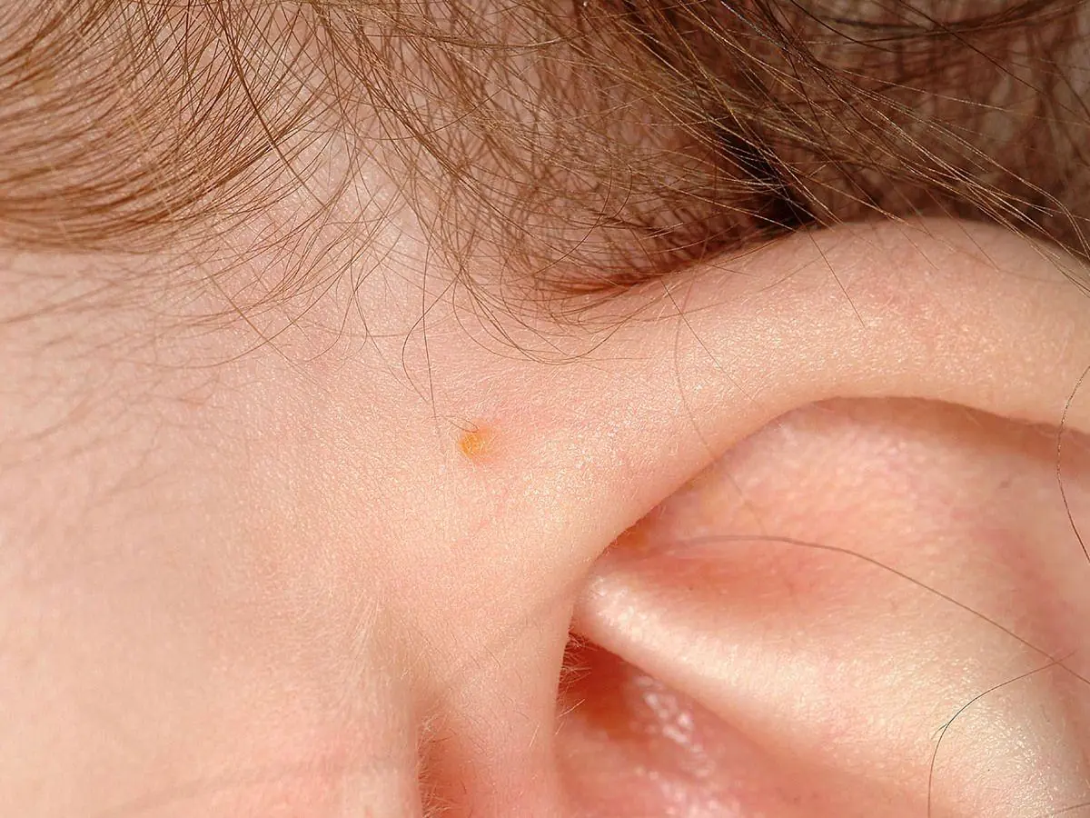 Discover the Meaning of This Tiny Ear Mark: Why Some People Are Born With a Small Hole Near Their Ear