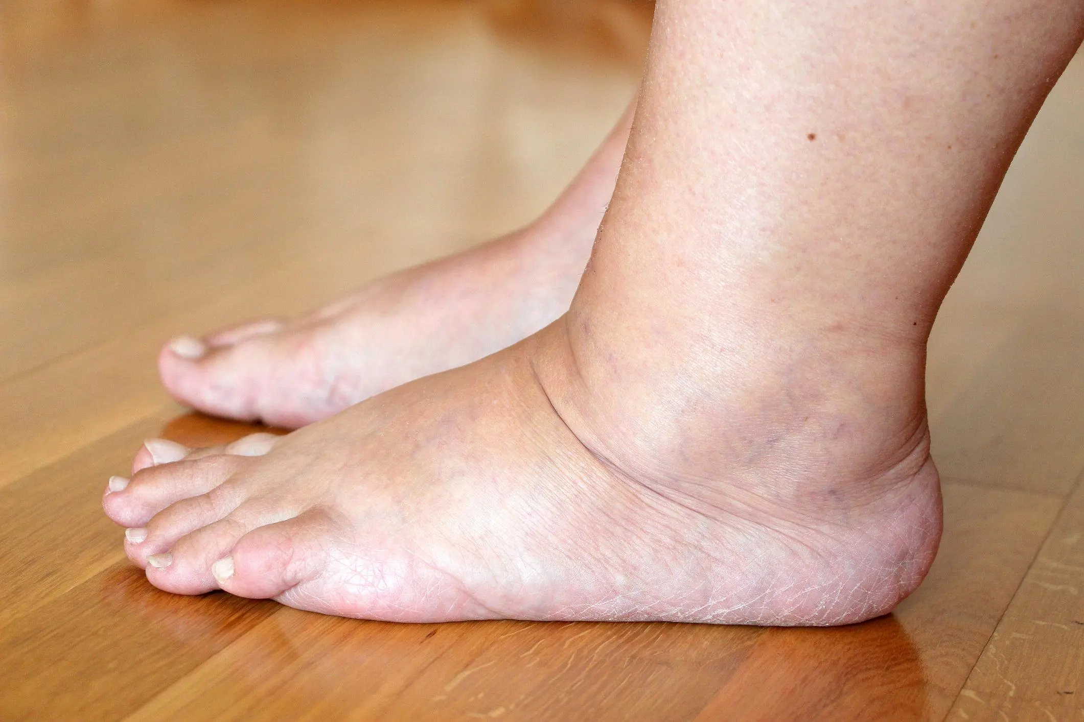 The Best Vitamin to Help Reduce Swollen Legs and Ankles: What You Need to Know
