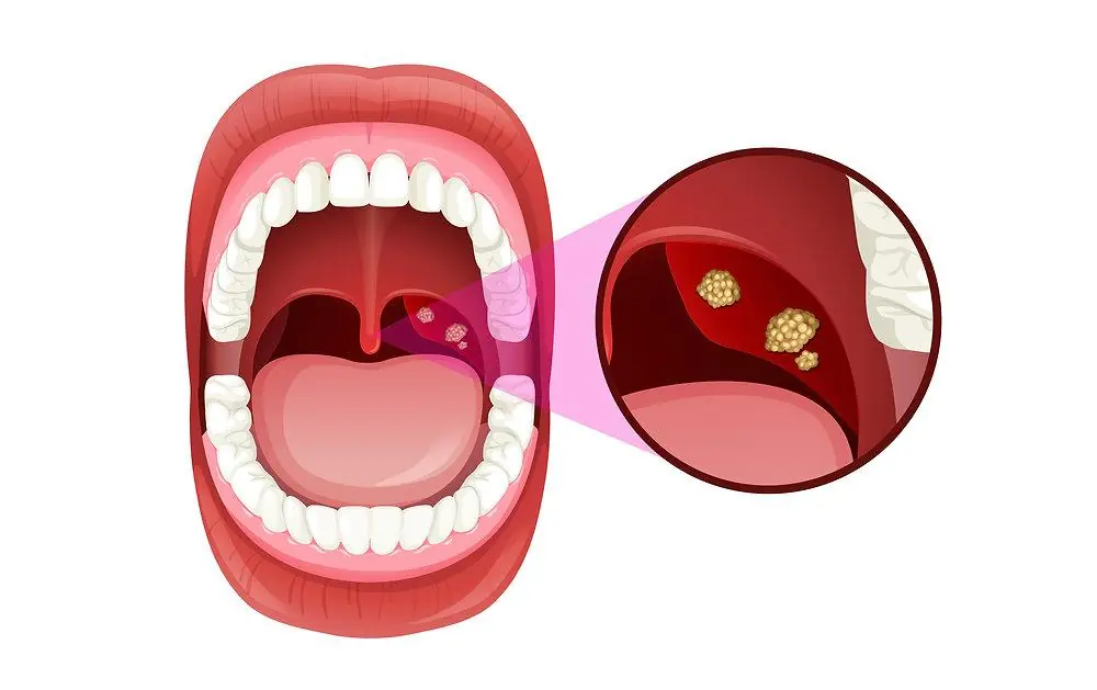 Tonsil Stones: What They Are, Why They Cause Bad Breath, and Natural Ways to Prevent Them