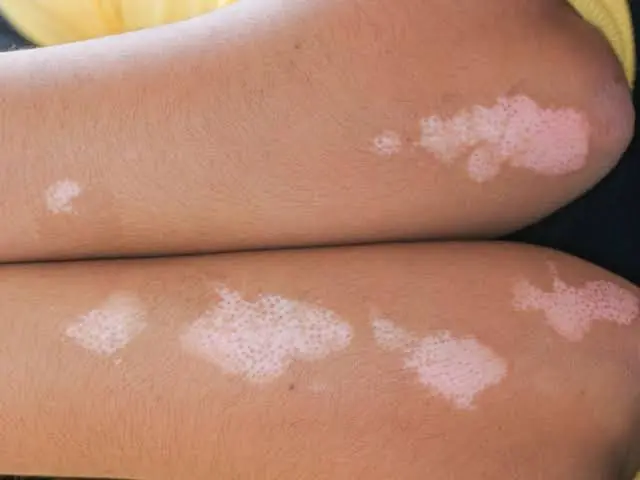Tiny White Spots Usually Aren't Serious—But Some Cases Shouldn't Be Ignored