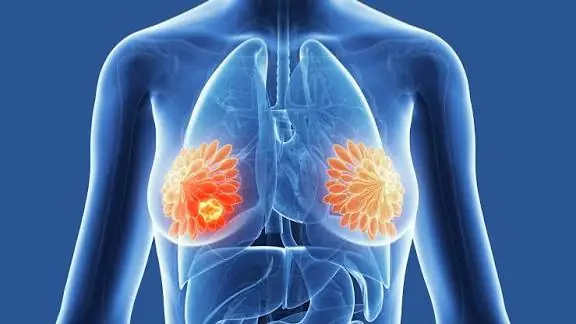 Early Detection Matters: 10 Breast Cancer Symptoms Everyone Should Know