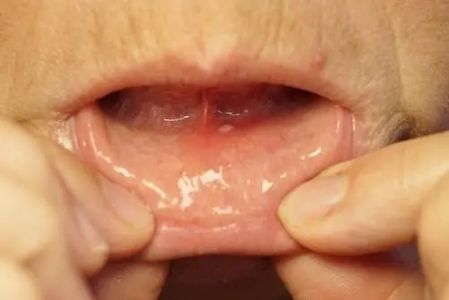 Hidden Dangers in Your Mouth: Early Signs of Oral Can.cer You Should Never Ignore