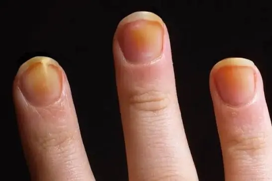 Have Your Nails Changed Recently? Here's What Experts Say