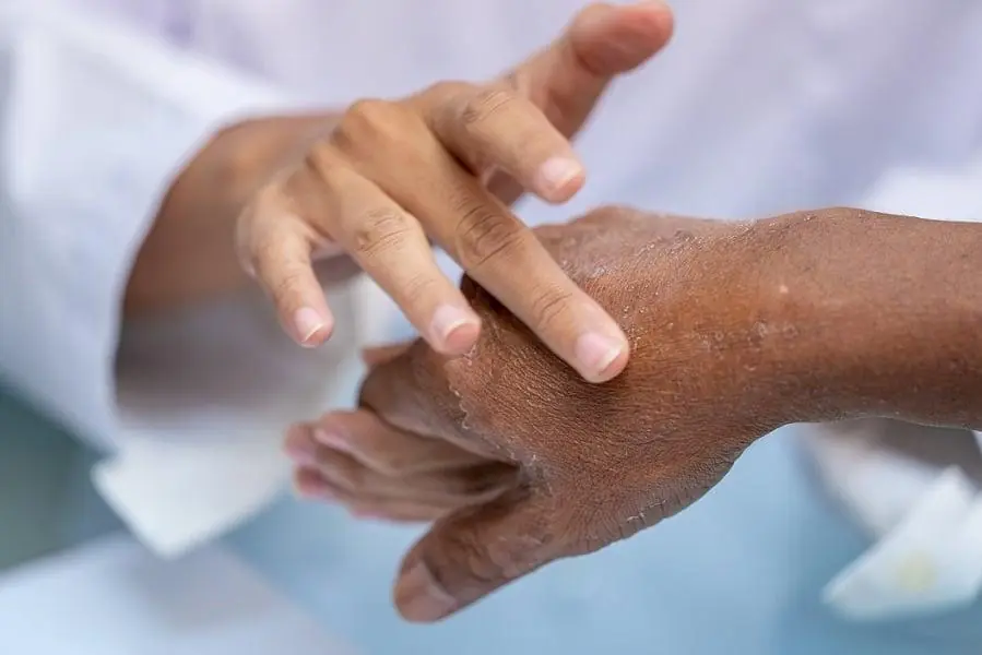 If the Skin on Your Hands Looks Like This, Your Body May Be Trying to Warn You