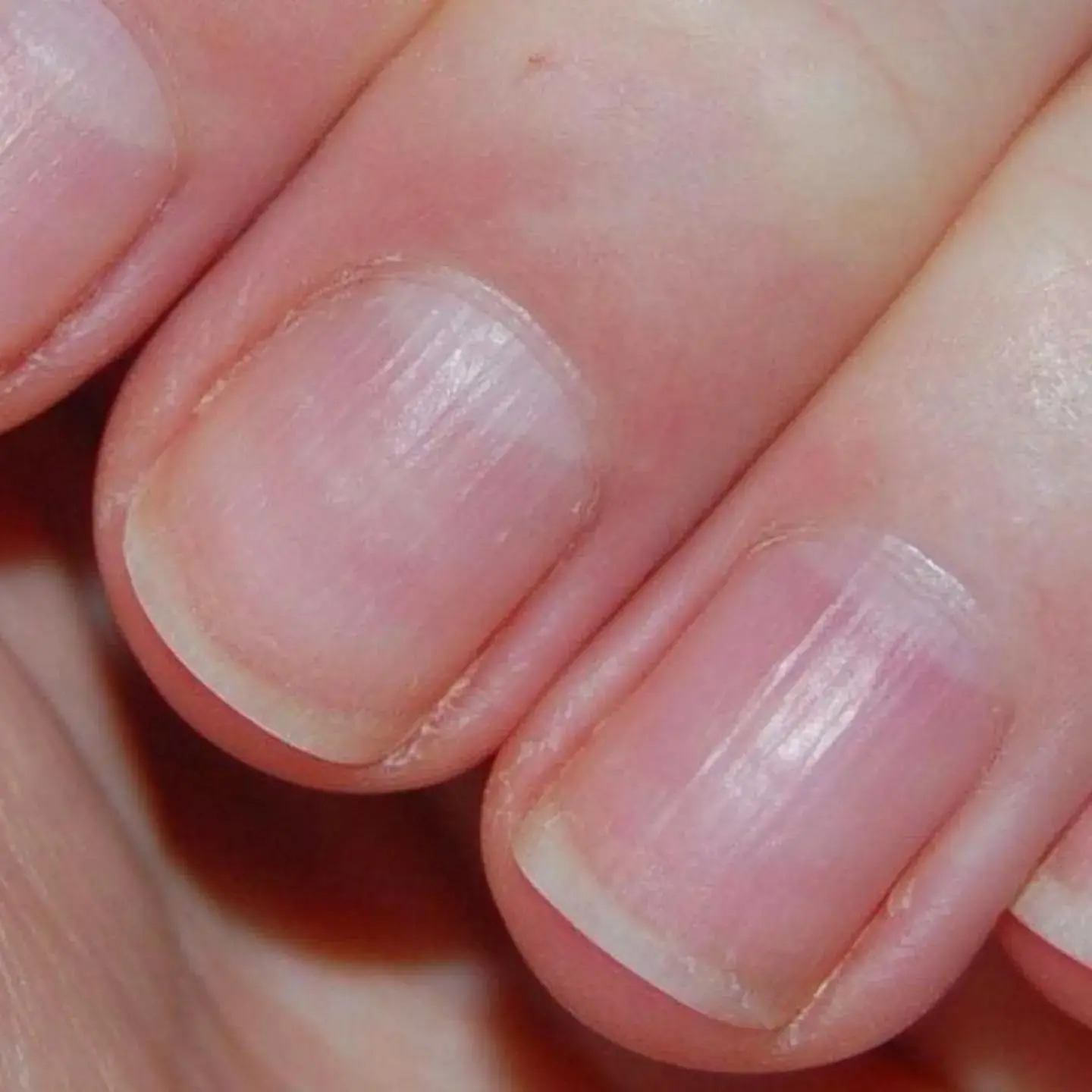 Lines on Your Nails May Reveal More Than Aging: What Vertical Ridges Could Be Telling You