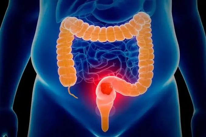 Could These 6 Subtle Changes Be Signs of Colon Cancer? Here's What to Know