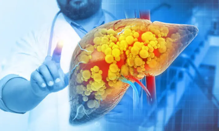 Could Your Body Be Warning You About Fatty Liver? Here Are 7 Signs