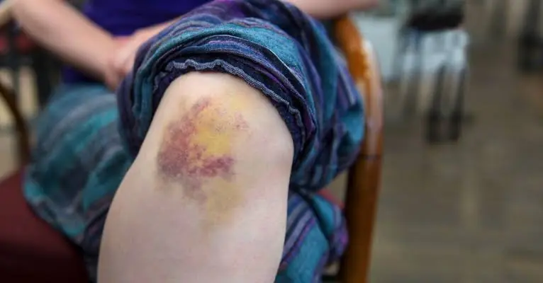 If You Notice These Types of Bruises Without an Injury, Here's What They Could Mean...