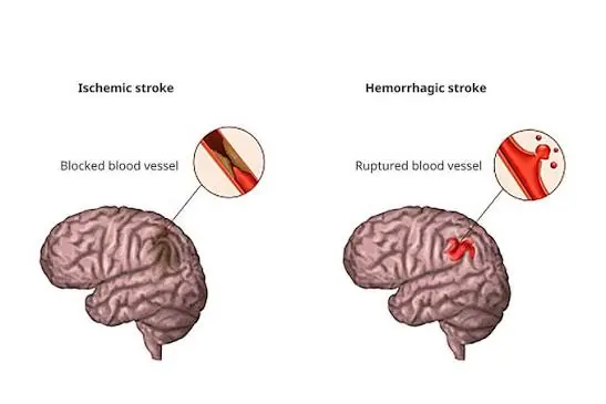 Recognizing These 10 Possible Stroke Warning Signs Could Make a Difference