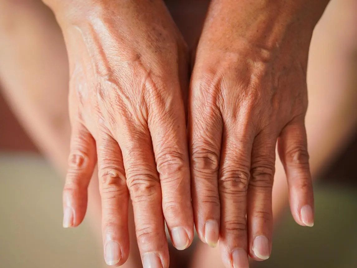 Visible Green Veins on Your Hands: What They Could Mean for Your Health