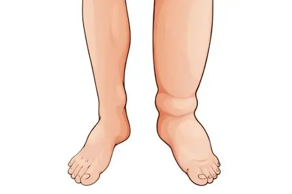 Leg Swelling Could Mean More Than You Think—Doctors Explain