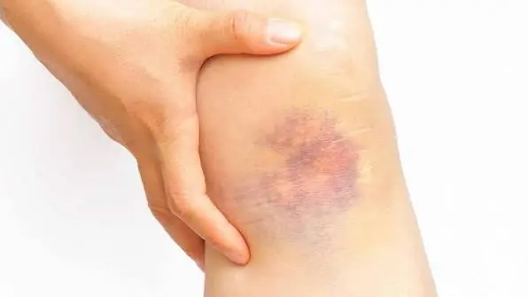 Persistent Bruises Could Point to More Than Just Minor Bumps.