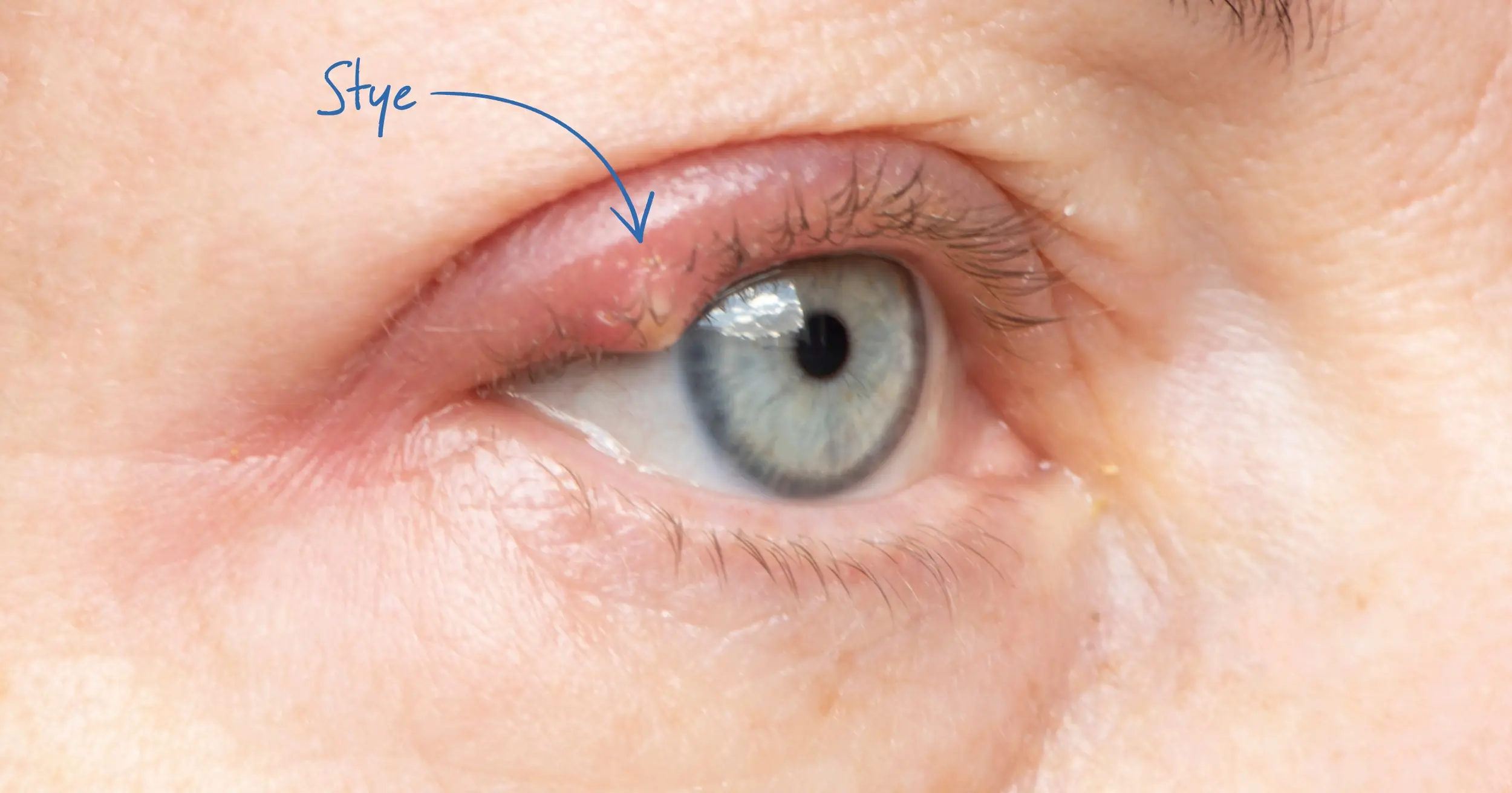 How to Get Rid of a Stye:  Effective Home Remedies and When to See a Doctor