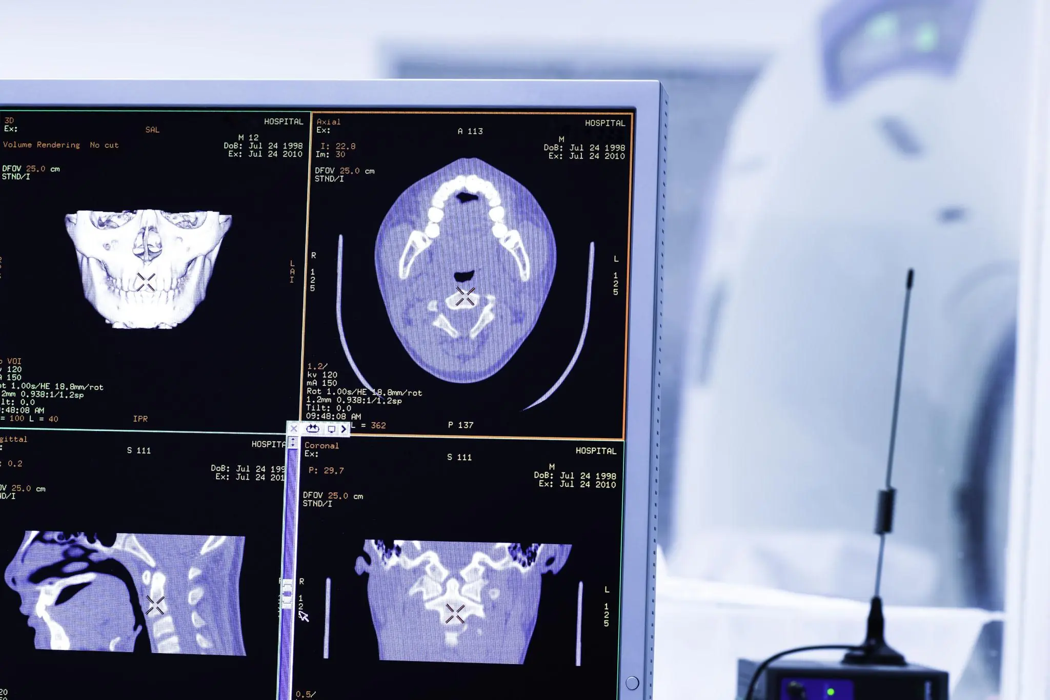 A Newlywed Wife Complained of a Headache Before Bed—Hours Later, She Suffered a Brain Hemorrhage