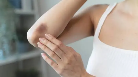 These Types of Bruises May Sometimes Signal an Underlying Health Issue