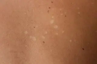 These Tiny White Spots Could Be a Sign of an Underlying Skin Condition