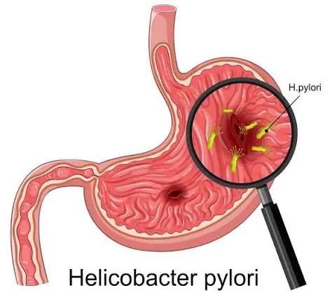 What You Should Know About H. pylori—The Hidden Infection Many People Miss