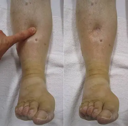 Don't Dismiss Swollen Legs—They Can Have Several Possible Causes