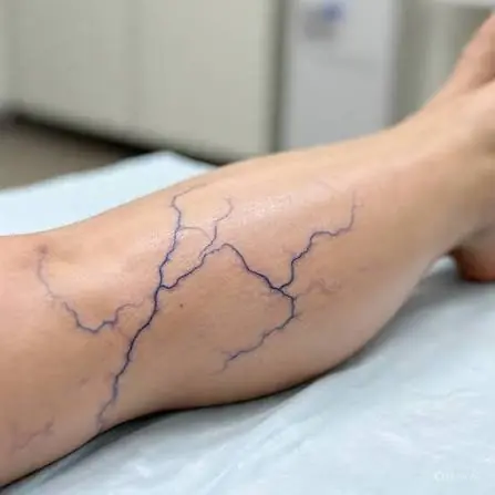 Visible Veins Aren't Always Just About Aging—Here's What to Know