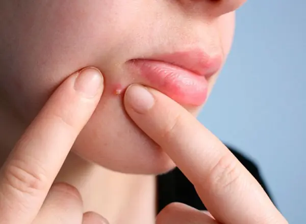 Why Am I Breaking Out? 10 Common Causes of Acne You Should Know