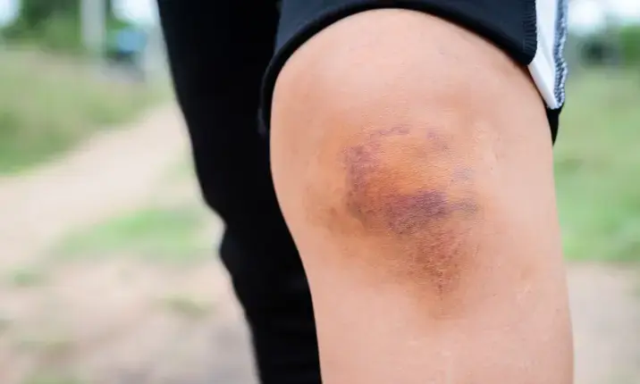 Easy Bruising Isn't Always Normal - Here's When to Pay Attention