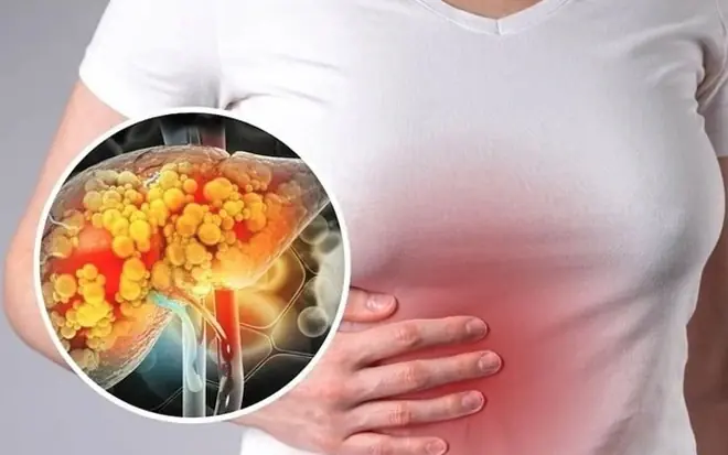 Fatty Liver Disease Explained: Risk Factors, Symptoms, and Evidence-Based Management