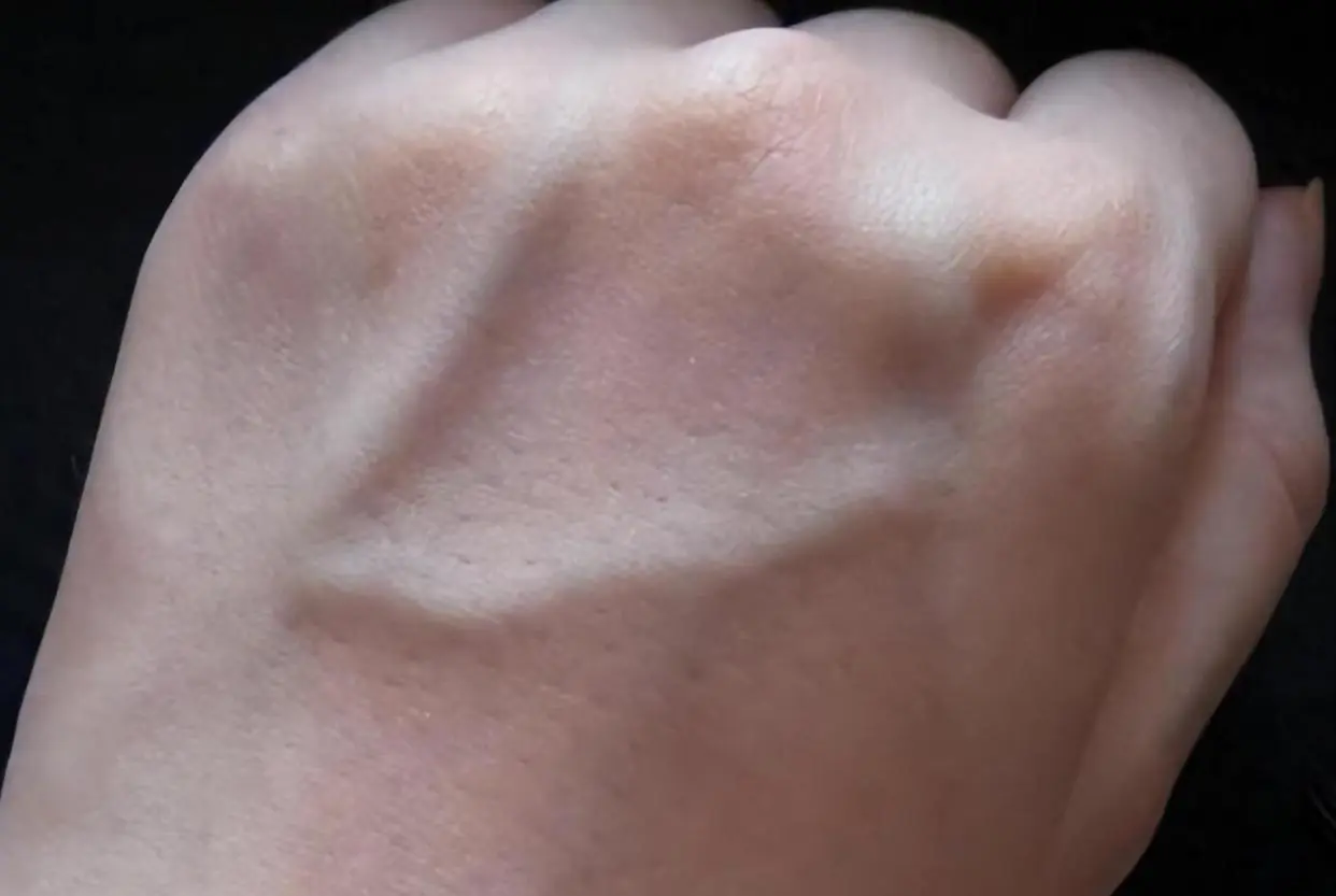 Visible Veins: When They're Normal, When They're Not, and When You Should Pay Attention