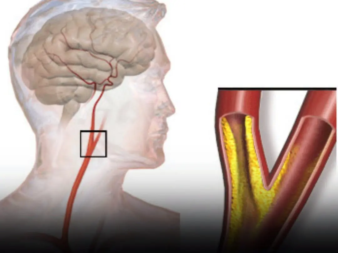 10 Warning Signs Your Arteries Might Be Clogged (Don’t Ignore These)