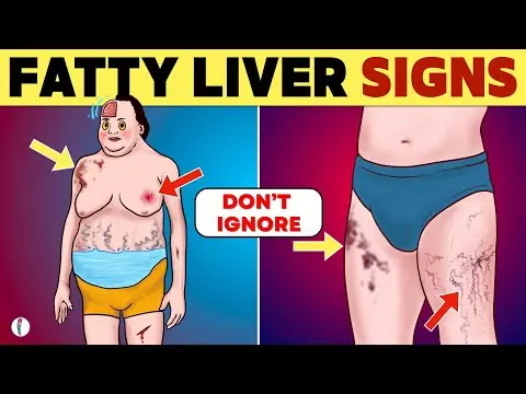 6 Symptoms of Fatty Liver Disease That Often Go Unnoticed