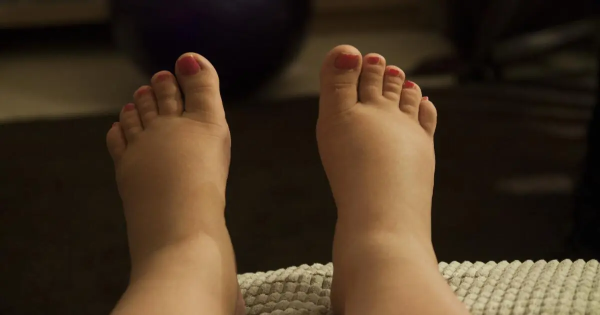 What Causes Swollen Feet and Ankles? Here Are the Most Common Reasons